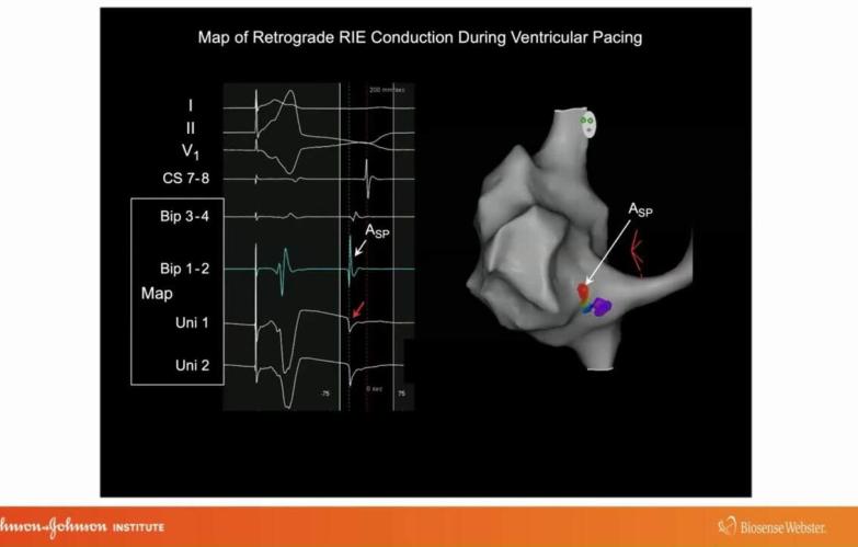 An Image From "Identifying the Antegrade and Retrograde Pathways in the Various Forms of AV Nodal Reentrant Tachycardia with Warren"Sonny" Jackman, MD"