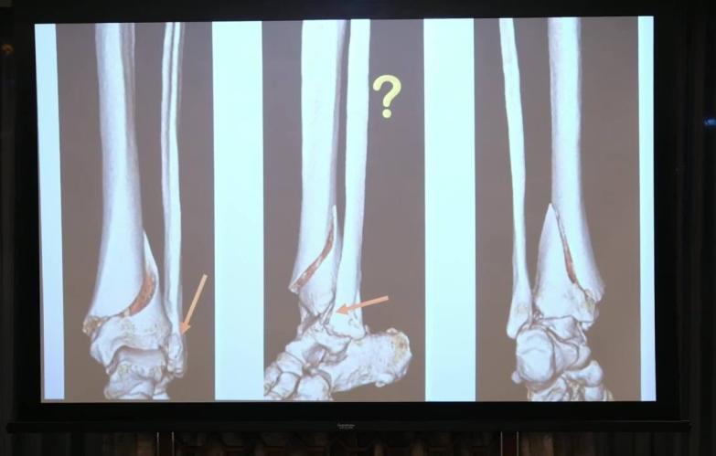 Complex Tibial Shaft Fractures Management