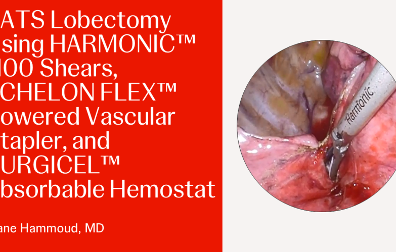 An image From "VATS Lobectomy Using HARMONIC™ 1100 Shears, ECHELON FLEX™ Powered Vascular Stapler, and SURGICEL™ Absorbable Hemostat"