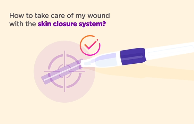 How to care for your wound with the skin closure system thumbnail