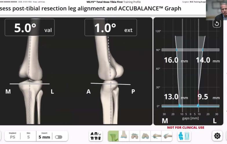VELYS Robotic-Assisted Solution Case Walkthrough with Dr. William Barrett thumbnail