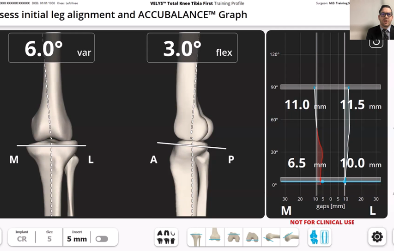 Image from VELYS Robotic-Assisted Solution Case Walkthough with Dr. Timothy Alton