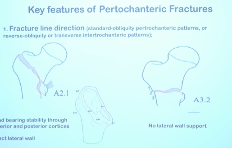 Intertrochanteric Fracture Surgical Pearls