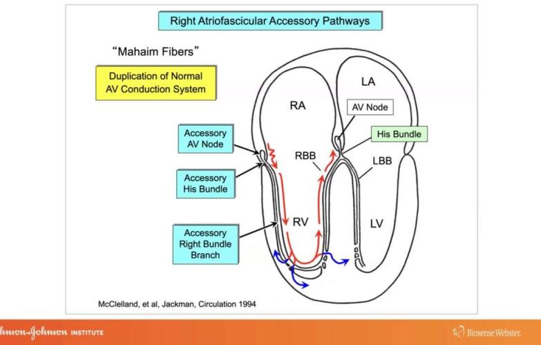 An Image From "Use of ECG and Intracardiac Recordings to Diagnose and Demonstrate the Electrophysiologic Characters of Atriofascicular and Atroventricular Type "Mahaim" Fibers with Warren 'Sonny' Jackman, MD"