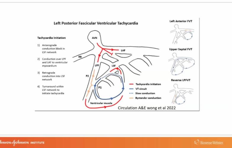An IMage From "Fascicular VT with Melvin Scheinman, MD"