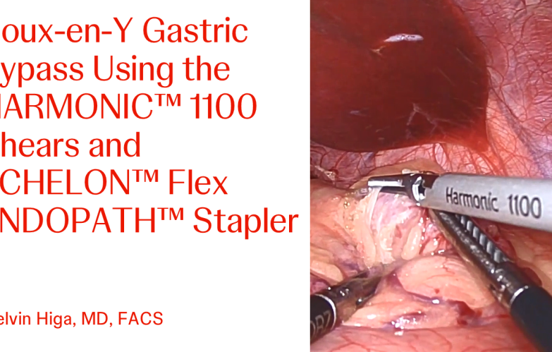 An Image From "Roux-en-Y Gastric Bypass Using the HARMONIC™ 1100 Shears and ECHELON™ Flex ENDOPATH™ Stapler with Kelvin Higa, MD"