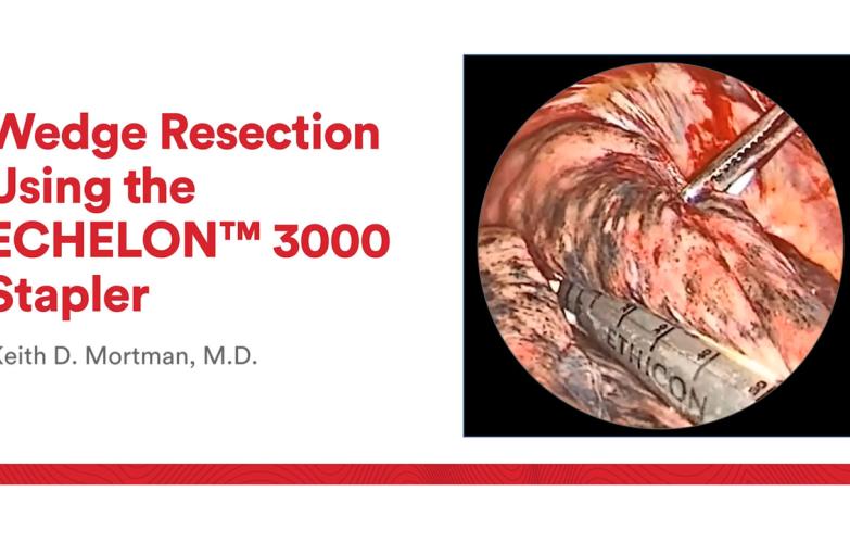 An Image From "Wedge Resection Using the ECHELON™ 3000 Stapler with Keith Mortman, MD"