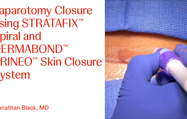 An Image From "Laparotomy Closure using STRATAFIX™ Spiral and DERMABOND™ PRINEO™ Skin Closure System with Jonathan Black, MD"