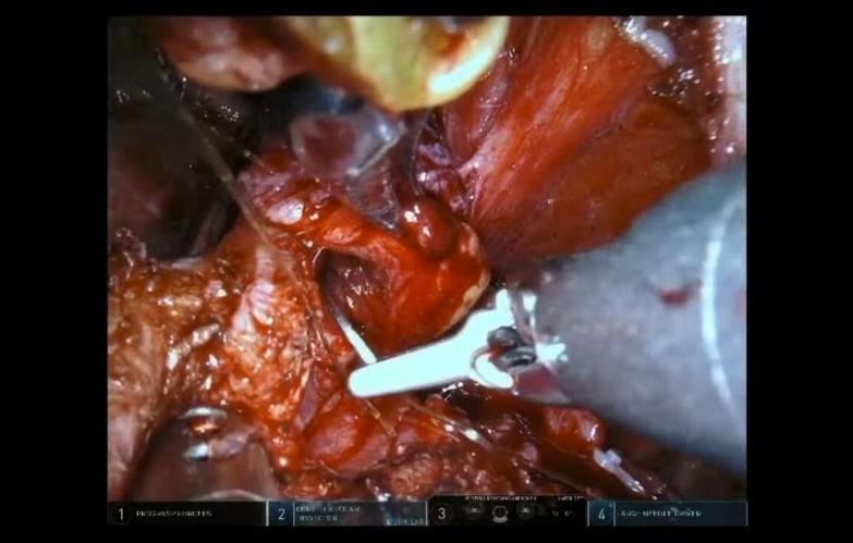 An Image From "Robotic Prostatectomy Using STRATAFIX™ Spiral Knotless Tissue Control Device with Jorn Witt, MD"