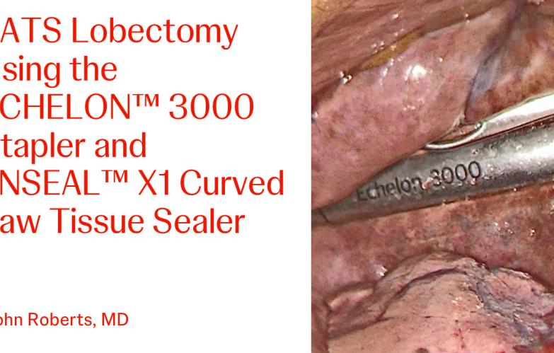 An Image From "Watch this video to learn more as Dr. Roberts performs a VATS procedure using the ECHELON™ 3000 stapler. This content is intended for Health Care Professionals in the United States. "