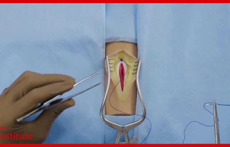 Abdominal Closure