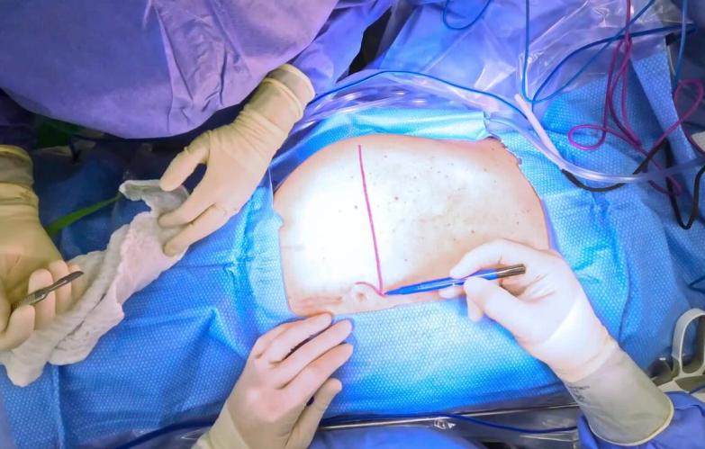 Right Hepatectomy - Incision