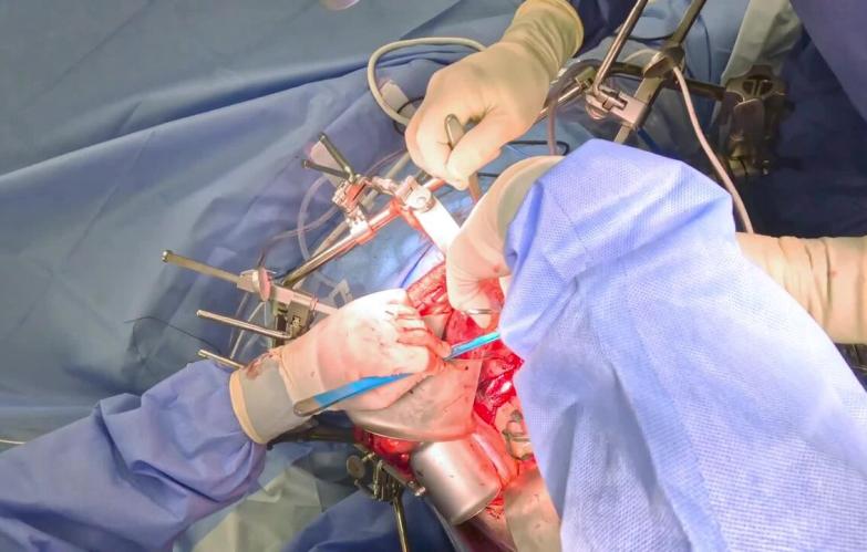 Right Hepatectomy - Inflow Control