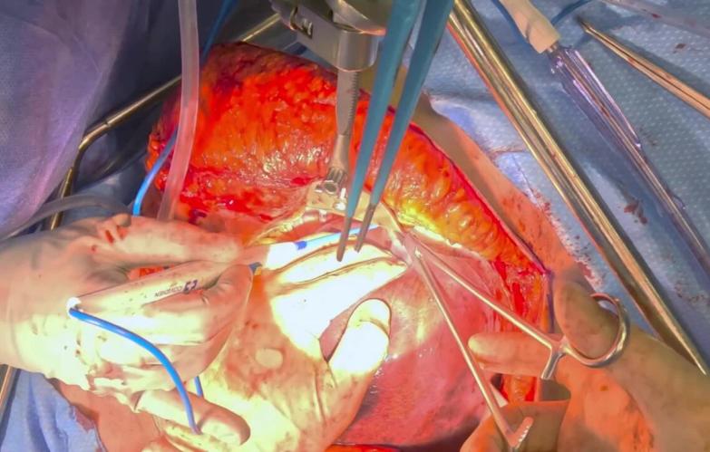 Right Hepatectomy - Mobilize Liver