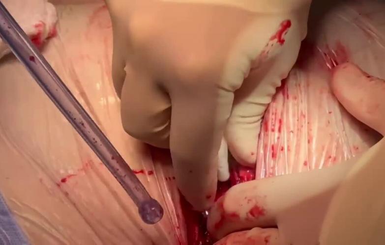 Coronary Artery Bypass Grafting (CABG) - Sternotomy Hemostasis