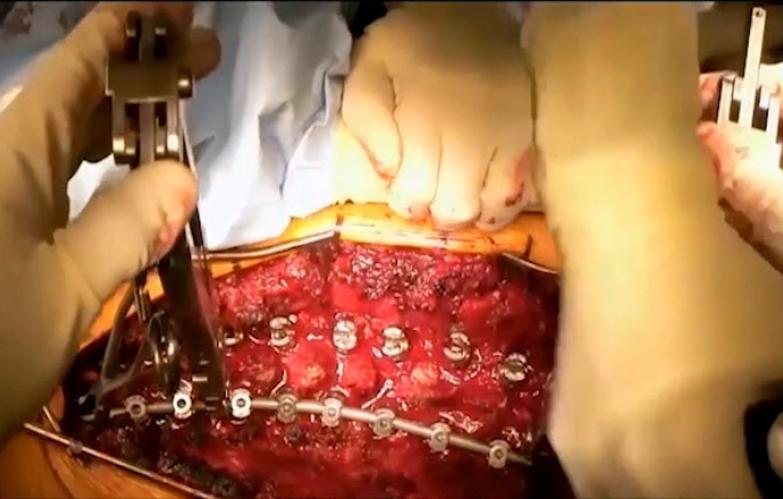 An image of the "Procedural Solutions for Spinal Deformity featuring Amer Samdani, MD" video.