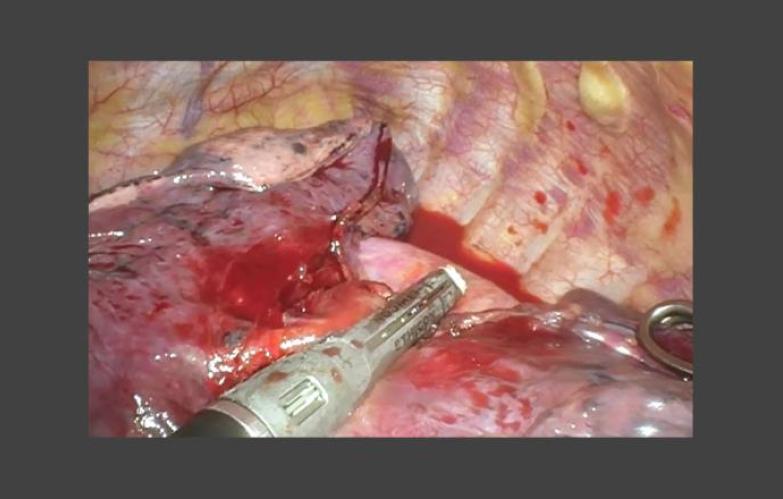 Repair during Right Upper Lobectomy with Zane Hammoud, MD