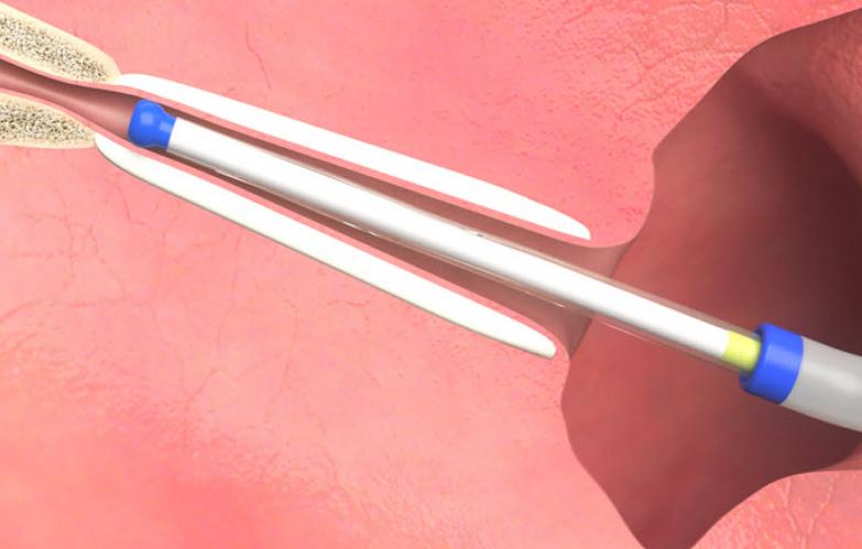 An image of the "ACCLARENT AERA Eustachian Tube Balloon Dilation System" video on the JnJInstitute.com website.