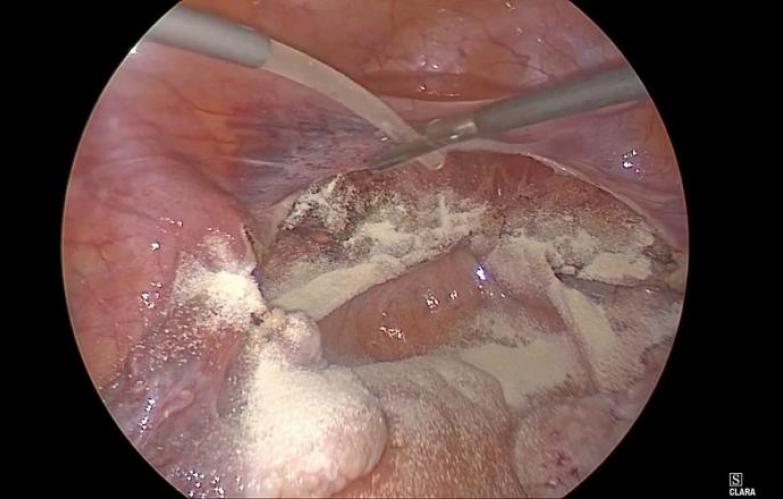 An image of the "Laparoscopic Vaginal Cuff Closure using SURGICEL® Powder Absorbable Hemostat with Kurian Thott, MD" video.