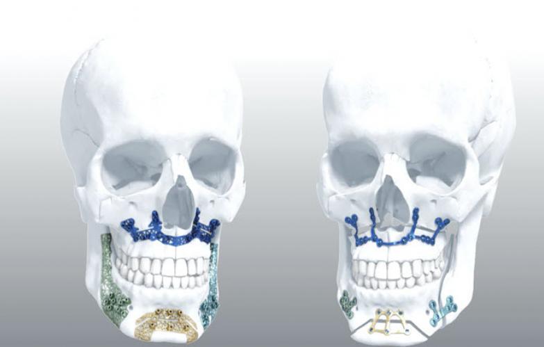 An image of the "TRUMATCH® Orthognathics Technique Animation" video from the JnJInstitute.com website.