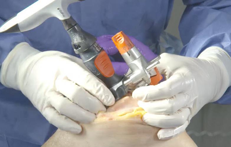 ATTUNE® Revision Fixed Bearing Knee System Cadaveric Surgery with Brian Haas, MD