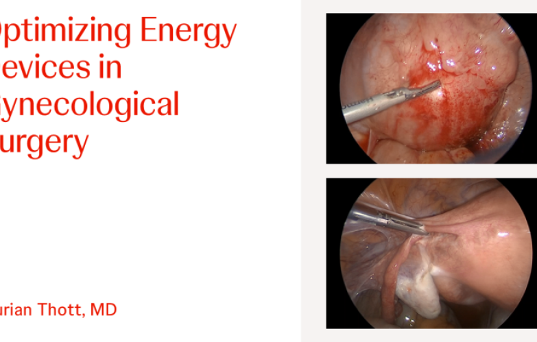 An Image From "Optimizing Energy Devices in Gynecological Surgery with Kurian Thott, MD"