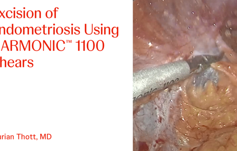 An Image From "Excision of Endometriosis Using HARMONIC™ 1100 Shears with Kurian Thott, MD"
