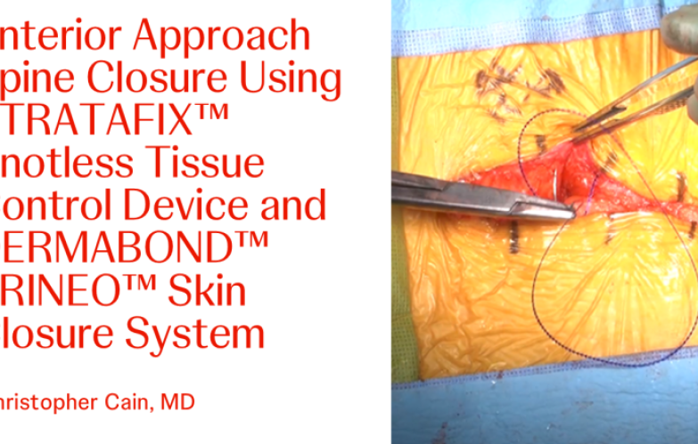 An image from the "Anterior Approach Spine Closure Using STRATAFIX™ Knotless Tissue Control Device and DERMABOND™ PRINEO™ Skin Closure System with Christopher Cain, MD" video on the JnJInstitute.com website.