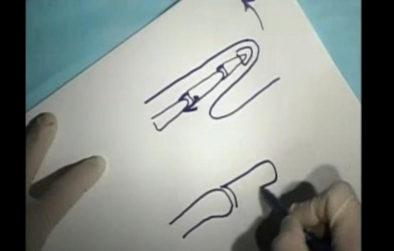 An image of the "Ulnar Collateral Ligament Repair with Donald Sheridan, MD" video on the JnJInstitute.com website.