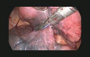 Fissure Transection During Right Upper Lobectomy by Zane Hammoud, MD