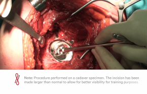 BiMentum Removal of Anchoring Pegs thumbnail