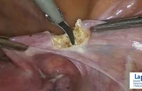 Image from: "Laparoscopic Radical Hysterectomy" on the jnjinstitute.com website