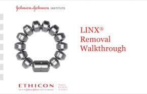 An image from the "LINX® Reflux Management System - Device Removal Walk-Through" video on the JnJInstitute.com website.