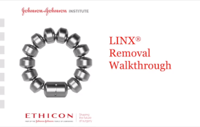 LINX® Reflux Management System - Device Removal Walkthrough