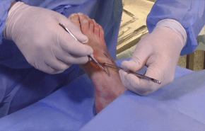 An image from the "Lisfranc Injuries - Procedural Demonstration Alan Ng, DPM, FACFAS" video on the JnJInstitute.com website.