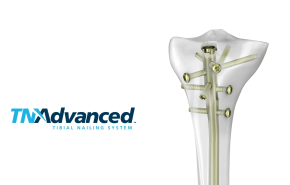 An image from the "TFN-ADVANCED Tibial Nailing System: Distal Locking with Matthew Graves, MD" video on the JnJInstitute.com website.