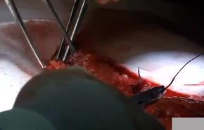 An image from the "XCM Biologic Tissue Matrix Component Separation Technique" video on the JnJInstitute.com website.