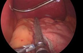 An image from "Sleeve Gastrectomy with the ECHELON 3000 stapler and ECHELON Staple Line Reinforcement"