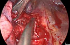 An Image From " VATS Wedge Resection and Lobectomy with ECHELON 3000 stapler, with John Roberts, MD"