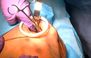 MatrixRIB™ System for Rib Fracture Fixation: Anterior Approach Presented by Nir Hus, MD thumbnail
