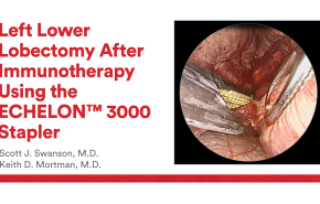 An image from " Left Lower Lobectomy After Immunotherapy Using the ECHELON 3000 Stapler with Scott Swanson, M
