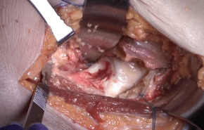Cutting the Capsule in an Anterior Approach with Tania Ferguson, MD