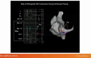 An Image From "Identifying the Antegrade and Retrograde Pathways in the Various Forms of AV Nodal Reentrant Tachycardia with Warren"Sonny" Jackman, MD"