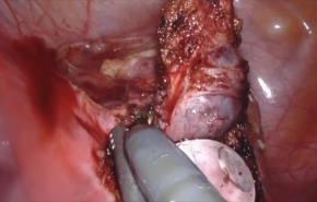 An Image From "Management of the Hiatal Hernia - Dr. Lipham"