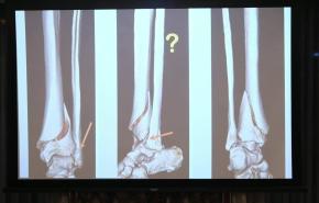 Complex Tibial Shaft Fractures Management