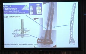 Tips and Tricks on Retrograde Nailing with Locking Attachment Washer System