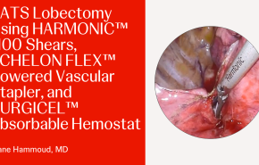 An image From "VATS Lobectomy Using HARMONIC™ 1100 Shears, ECHELON FLEX™ Powered Vascular Stapler, and SURGICEL™ Absorbable Hemostat"