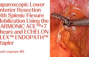 Laparoscopic Lower Anterior Resection with Splenic Flexure Mobilization 
