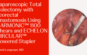 Laparoscopic Total Colectomy with Ileorectal Anastomosis Using HARMONIC™ 1100 Shears and ECHELON CIRCULAR™ Powered Stapler
