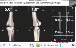 VELYS Robotic-Assisted Solution Case Walkthrough with Dr. William Barrett thumbnail